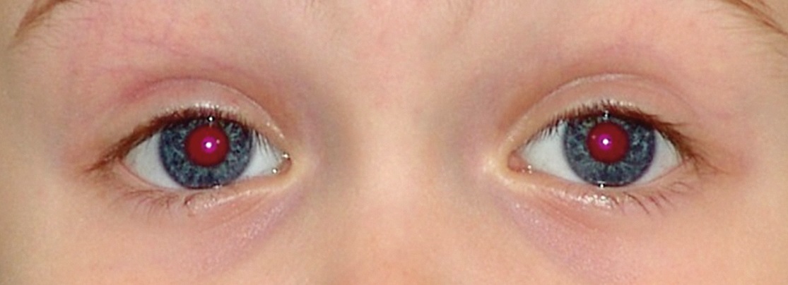 Fundus red reflex Fundus red reflex